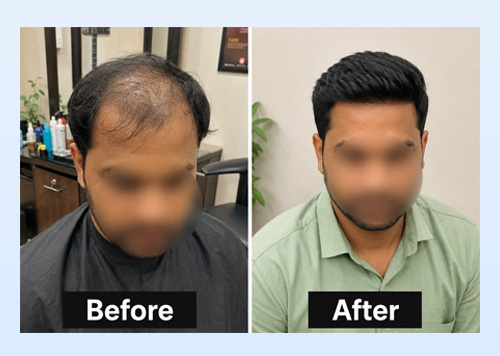 Non Surgical Hair Replacement
