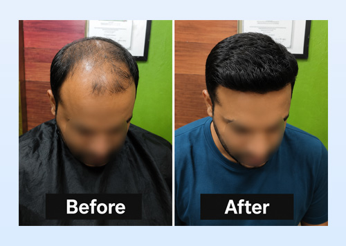 hair replacement in Udaipur