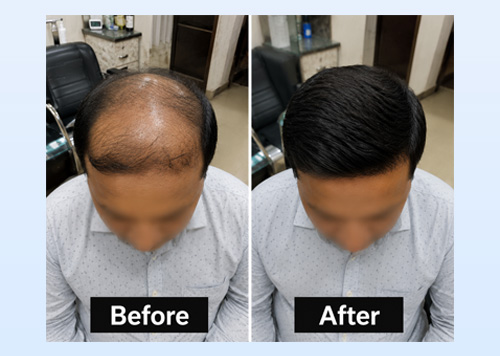 Hair Bonding in Udaipur