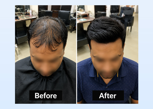Hair Replacement in Udaipur