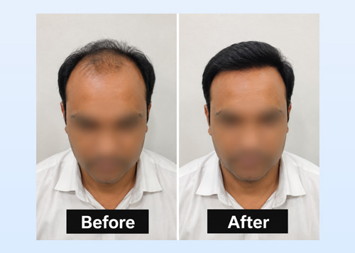 Hair Patch in Udaipur